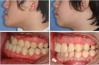 成人过敏可以矫正吗视频,揭秘改善过敏体质的新途径