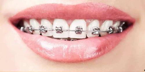 成人兜齿正畸视频,视频解析与成功案例分享